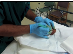 another abscess gets drained