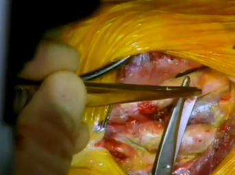 Aorta Graft, Renal Vein: Bleeding Behind Aorta and Bleeding from Renal Vein (Alan B. Lumsden, MD) Aorta Graft, Renal Vein: Bleeding Behind Aorta and Bleeding from Renal Vein (Alan B. Lumsden, MD)