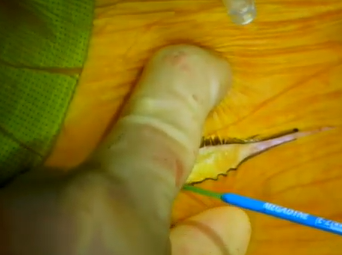 Aorta to Right Carotid Bypass (A. Lumsden, MD, M. Ramchandani, MD, E. Andraos, MD, M. Zubair, MD) Aorta to Right Carotid Bypass (A. Lumsden, MD, M. Ramchandani, MD, E. Andraos, MD, M. Zubair, MD)