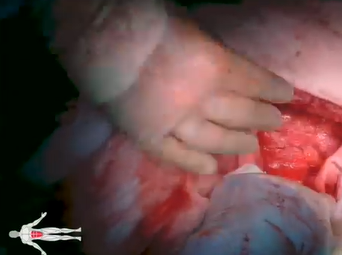 Aorta to Superior Mesenteric Artery and Hepatic Artery Bypass (Eric Peden, MD, Manuel Rojo, MD) Aorta to Superior Mesenteric Artery and Hepatic Artery Bypass (Eric Peden, MD, Manuel Rojo, MD)