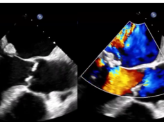 Aortic and Mitral Valve Endocarditis Due to Austin Flint Phenomenon