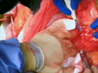 Aortic Pseudoaneurysm Repair (Charudatta Bavare, MD, Philip Auyang, MD) Aortic Pseudoaneurysm Repair (Charudatta Bavare, MD, Philip Auyang, MD)