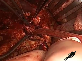 Aorto Bi-Iliac Graft: Dividing Proximal Aorta Parachute Technique (A. Lumsden, MD & M. Reardon, MD) Aorto Bi-Iliac Graft: Dividing Proximal Aorta Parachute Technique (A. Lumsden, MD & M. Reardon, MD)