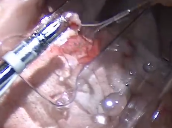 Aorto-Hepatic Bypass Using a Novel Aortic Anastomotic Device (MATTHEW BENNETT, MD) Aorto-Hepatic Bypass Using a Novel Aortic Anastomotic Device (MATTHEW BENNETT, MD)