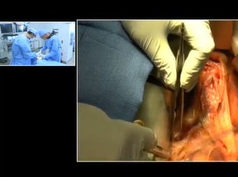 Aorto Iliac PTFE Graft (JOHN EIDT MD, CARLOS BECHARA, MD, ALAN LUMSDEN, MD) Aorto Iliac PTFE Graft (JOHN EIDT MD, CARLOS BECHARA, MD, ALAN LUMSDEN, MD)