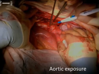 Aortobifemoral Bypass (Maham Rahimi, MD, PhD, RPVI and Travis Vowels, MD) Aortobifemoral Bypass (Maham Rahimi, MD, PhD, RPVI and Travis Vowels, MD)