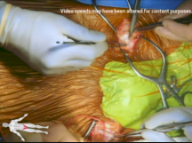 Aortobifemoral Bypass with SMA Bypass Aortobifemoral Bypass with SMA Bypass