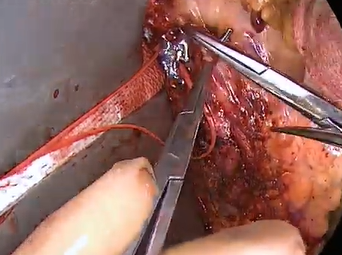 Aortorenal Bypass (Alan B. Lumsden, MD, M. Mujeeb Zubair MD, Luis Gomez, MD) Aortorenal Bypass (Alan B. Lumsden, MD, M. Mujeeb Zubair MD, Luis Gomez, MD)