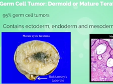 APGO Basic Sciences - Topic 22: Ovarian Neoplasm
