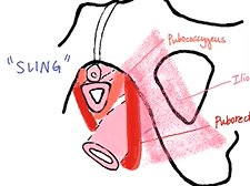 APGO Basic Sciences - Topic 24: Pelvic Organ Prolapse