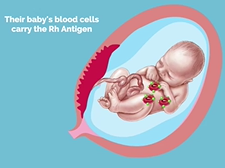 APGO Basic Sciences - Topic 4: Alloimmunization
