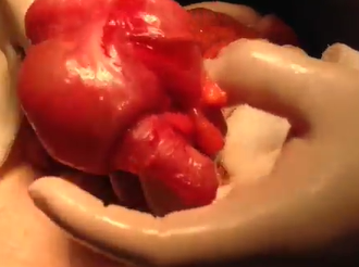 Appendiceal Neoplasm Presenting as Adult Intussusception