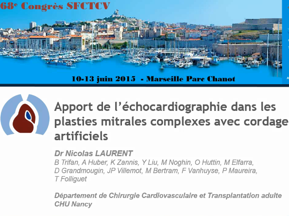 Apport de l'échocardiographie transthoracique pour prédire la longueur des cordages artificiels Apport de l'échocardiographie transthoracique pour prédire la longueur des cordages artificiels