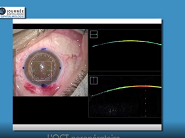 Apport de l'OCT per-opératoire en chirurgie cornéenne