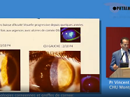 Apport du laser Femtoseconde et de l'OCT per opératoire en chirurgie cornéenne Apport du laser Femtoseconde et de l'OCT per opératoire en chirurgie cornéenne