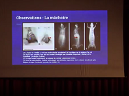 Apports de lostéopathie sur la lombalgie chronique