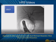 Approach to Safe Laparoscopic Cystic Duct Remnant Resection: More Than Just Careful Dissection Approach to Safe Laparoscopic Cystic Duct Remnant Resection: More Than Just Careful Dissection