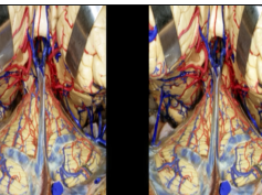 Approaches to the Brainstem (3D)
