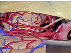 Approaches to the Brainstem