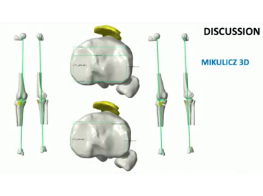 Approche tridimensionnelle et "patient spécifique" des ostéotomies Approche tridimensionnelle et "patient spécifique" des ostéotomies