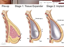 Are All Breast Reconstructions Equal?: Plastic Surgery Hot Topics with Rod J. Rohrich, MD Are All Breast Reconstructions Equal?: Plastic Surgery Hot Topics with Rod J. Rohrich, MD