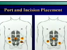 Are there reasons to use a hand-assist technique in Crohns resection? Are there reasons to use a hand-assist technique in Crohns resection?