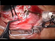 Argus II Epiretinal Prosthesis System Implantation in an End stage Retinitis Pigmentosa Argus II Epiretinal Prosthesis System Implantation in an End stage Retinitis Pigmentosa