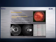 Argus II Epiretinal Prosthesis System Implantation in End-stage Retinitis Pigmentosa Argus II Epiretinal Prosthesis System Implantation in End-stage Retinitis Pigmentosa