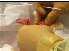 Arm Abscess Drained (Cysts, Boils and Abscesses)