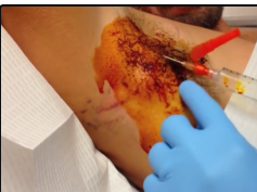 Armpit Abscess Core Removal, Part One