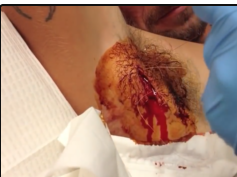 Armpit Abscess Core Removal, Part Two