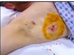 Armpit Abscess Drainage Proceure in Emergency Room