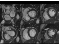 Arrhythmogenic Cardiomyopathy