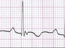 Arrhythmogenic RV Dysplasia