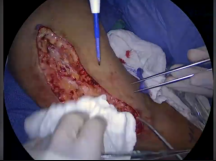 Arteriovenous Fistula (AVF) Superficialization Arteriovenous Fistula (AVF) Superficialization