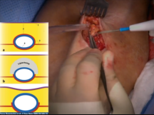 Arteriovenous Fistula (AVF) Superficialization Arteriovenous Fistula (AVF) Superficialization