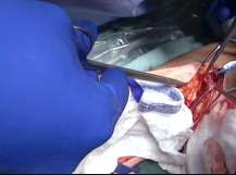 Arteriovenous Fistula Creation - Brachiobasilic Transposition Arteriovenous Fistula Creation - Brachiobasilic Transposition