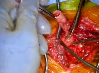 Ascending Aorta to Bilateral Axillary Artery Bypass (Lumsden, MacGillivray, Auyang, Chinnadurai) Ascending Aorta to Bilateral Axillary Artery Bypass (Lumsden, MacGillivray, Auyang, Chinnadurai)