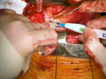 Ascending Aortic Debranching (Marvin D. Atkins Jr , MD, M. Mujeeb Zubair, MD) Ascending Aortic Debranching (Marvin D. Atkins Jr , MD, M. Mujeeb Zubair, MD)