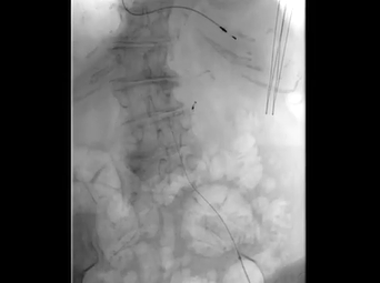Ascending Saccular Aneurysm Repair Using Gore Aortic Cuffs (Marvin Atkins, MD; M. Mujeeb Zubair, MD) Ascending Saccular Aneurysm Repair Using Gore Aortic Cuffs (Marvin Atkins, MD; M. Mujeeb Zubair, MD)