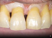 Atraumatic Root Extraction by means of an endodontic file