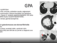 Atteinte trachéo bronchique des granulomatoses