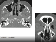 Atteintes des voies aériennes hautes