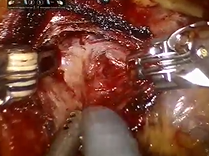 AUA Teaching Videos: Nerve-sparing technique during robotic radical cystoprostatectomy AUA Teaching Videos: Nerve-sparing technique during robotic radical cystoprostatectomy