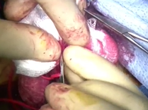 AUA Teaching Videos: Proximal Hypospadias - 1 Stage Repair