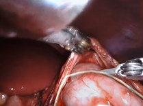 AUA Teaching Videos: Robotic Ureterocalicostomy