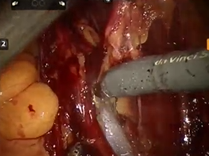 AUA Urology Teaching Videos:Robotic-Assisted Extended Lymph Node Dissection for Pelvic Malignancies AUA Urology Teaching Videos:Robotic-Assisted Extended Lymph Node Dissection for Pelvic Malignancies