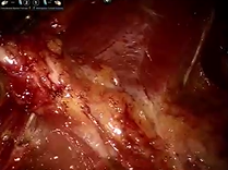 AUA Urology Teaching Videos: Robotic repair of left uretero-neobladder anastomotic stricture AUA Urology Teaching Videos: Robotic repair of left uretero-neobladder anastomotic stricture