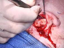 Auricular Cartilage Graft Harvest