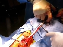 Autologous Fascia Lata Spiral Sling